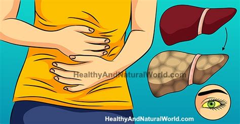 Fatty Liver Hepatic Steatosis Signs Symptoms And Prevention