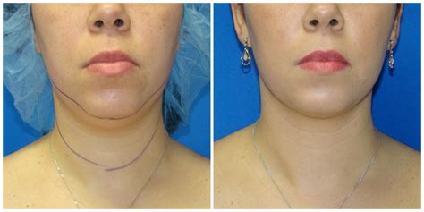 Patient 251 Female Liposuction Before And After Photos Katy Plastic