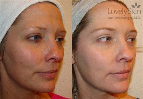 Ipl Treatment Before And After Photos Skin Specialists