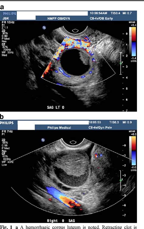 √ Ovarian Cancer Ultrasound Color Doppler Using Color Doppler To