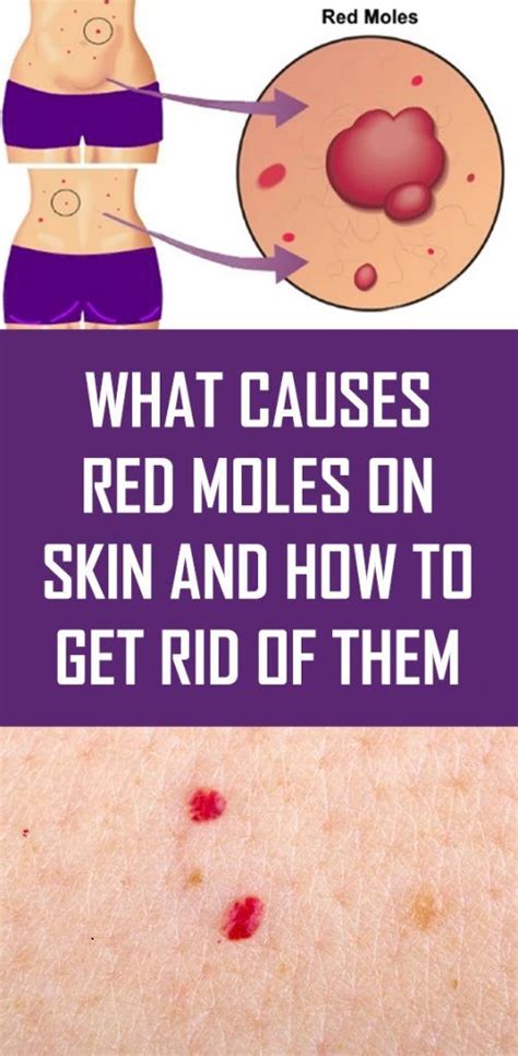 What Causes Red Moles On Skin And How To Get Rid Of Them Red Moles