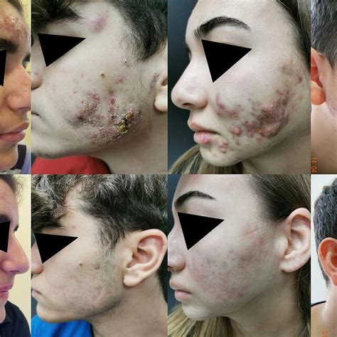 Clinical Appearance Of Acne Fulminans In Four Patients Before And After
