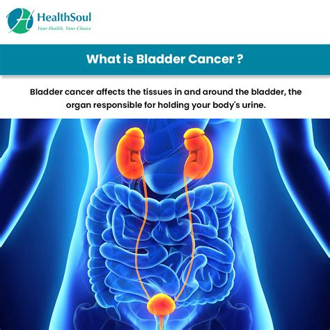 Bladder Cancer Symptoms And Treatment Healthsoul