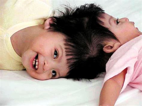 Josie Hull And Teresa Cajas Formerly Conjoined Twins 21 Years Later