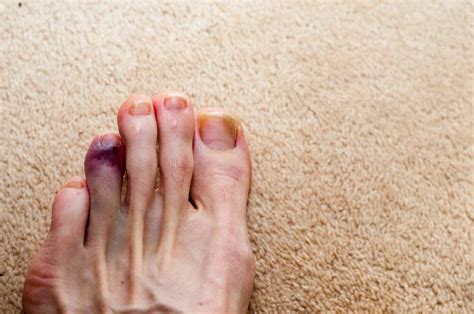 Health Tip Help A Broken Toe Heal Healthstatus