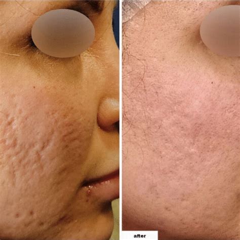 A 32 Year Old Female With Grade 3 Acne Scars Improving To Grade 2 On
