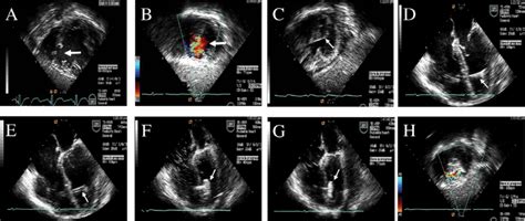 Tee Images During Hybrid Or Periventricular Device Closure Of A