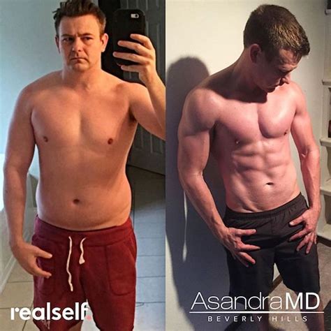 Patient 289 Testosterone Replacement Therapy Before And After Photos