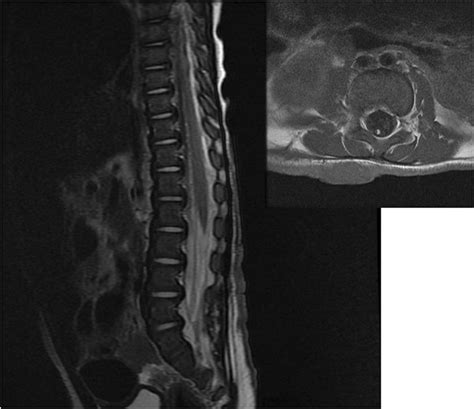 T2 Weighted Sagittal Left Mri Showing Low Lying Conus Medullaris And