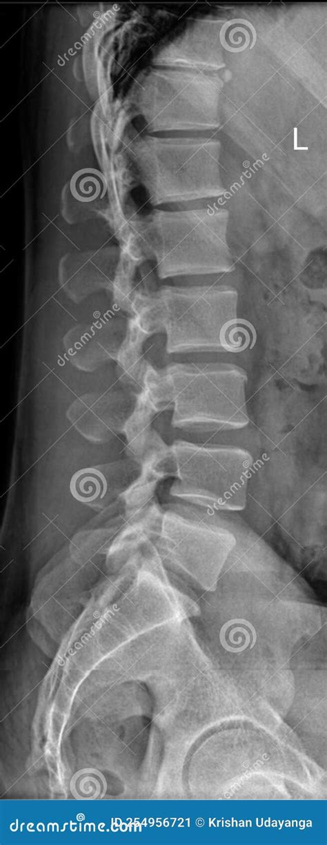Lumbar Spine Radiographic Anatomy Stock Image Image Of Vertebrae