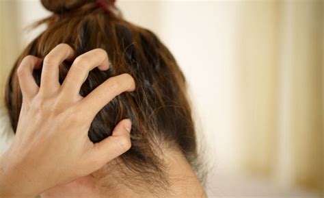 Plaques Cuir Chevelu Psoriasis Ou Eczéma Des Cheveux Comment Traiter