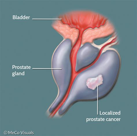 These signs usually indicate that cancer has spread to other parts of your body such as the liver or stomach. What is Localized or Locally Advanced Prostate Cancer? | PCF