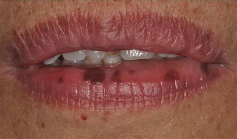 Lenticular Melanotic Macule On The Lower Lip Of A Laugier Hunziker