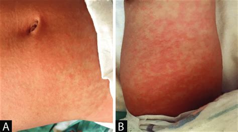Maculopapular Rashes In The Abdomen Region A And Leg B Of The Case Download Scientific