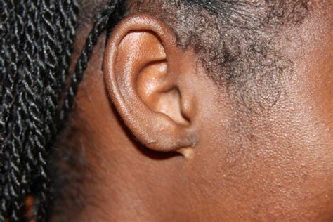 Poor Surgical Outcome Keloid Removal Expert New York