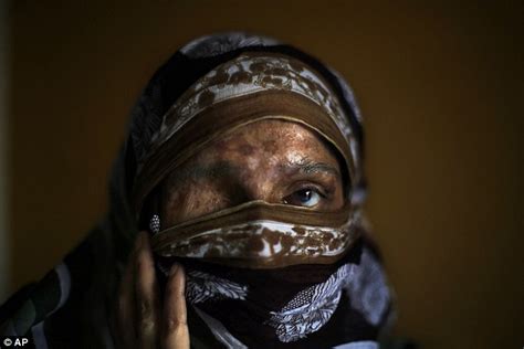 Indian Government Not Doing Enough To Stop Acid Attacks On Women Say Victims Who Believe New