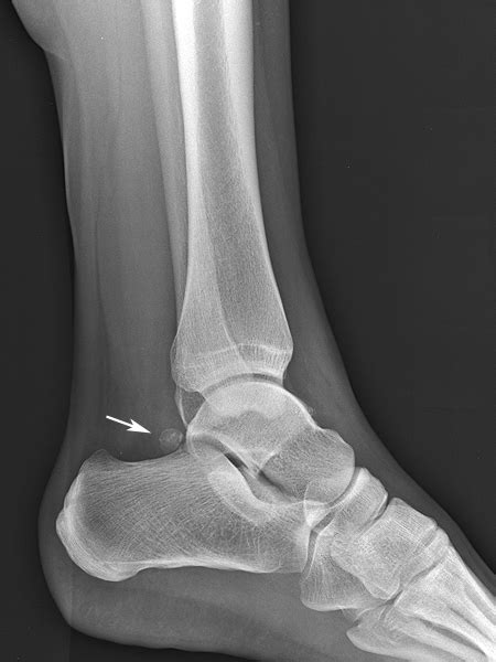 Lateral Radiograph Of Right Ankle Showing An Os Trigonum And Posterior