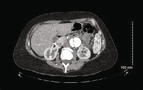 Ct Scan Of The Abdomenpelvis With Iv Contrast Demonstrating Dissection