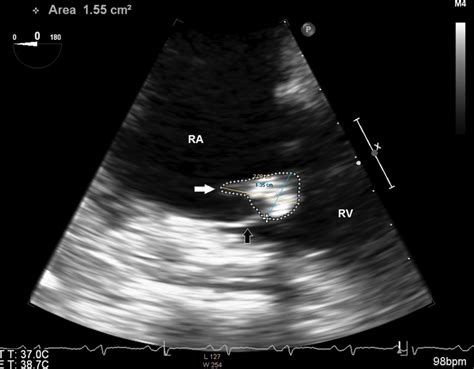 A Case Of Tricuspid Valve Non Bacterial Thrombotic Endocarditis