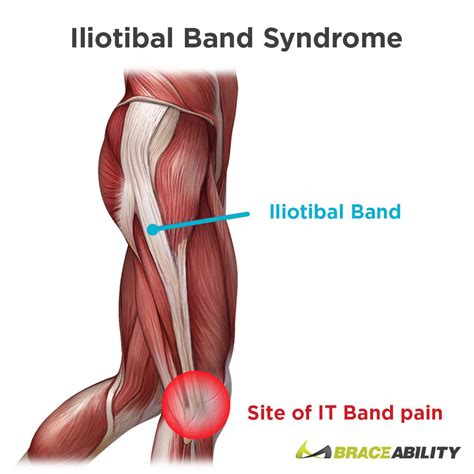 Iliotibial Band Syndrome It Band Stretchs Exercises And Treatment