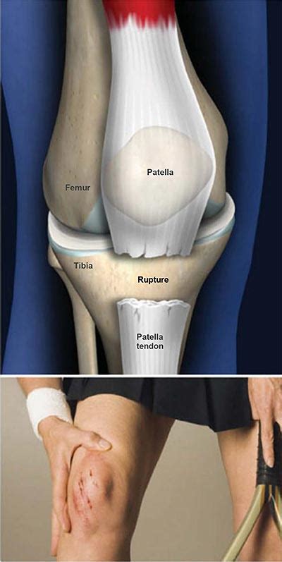 Patella Tendon Rupture Central Coast Orthopedic Medical Group