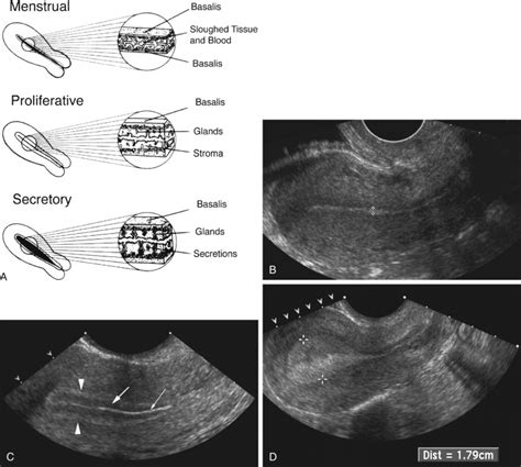 Ultrasound Evaluation Of The Uterus Obgyn Key
