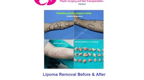 Lipoma Removal Results Lipoma Treatment Before And After Photos