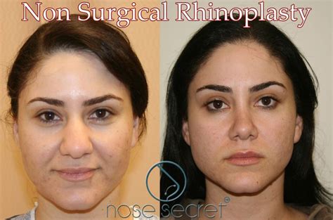 If you often think about the shape and structure of your nose, this simple exercise will be very. Pin on Nose job