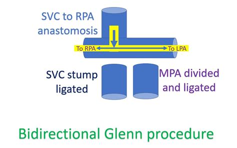 What Is A Bidirectional Glenn Procedure Bdg All About