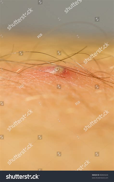 Side View Pimple Extreme Macro Ingrown Stock Photo 96965633 Shutterstock