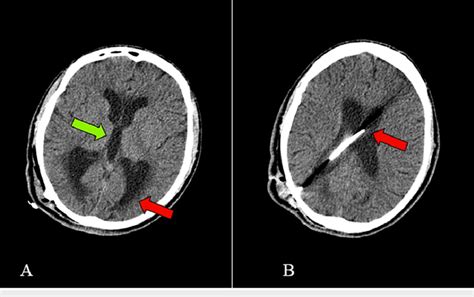 Hydrocephalus And Proximal Catheter A Axial Section Of A Ct Scan