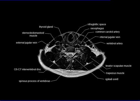 Musculoskeletal anatomy, kinesiology, and palpation for manual therapists. MRI neck anatomy | free MRI axial neck cross sectional anatomy
