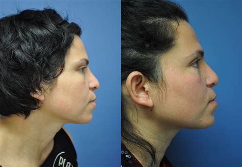 Rhinoplasty Before And After Pictures Washington Dc And Columbia Md