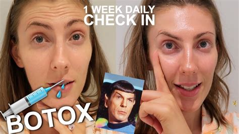 1 Week After Botox Daily Updates And Results Spock Brows First