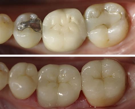 Before And After Patient Had Two Molars With Old Broken Composite