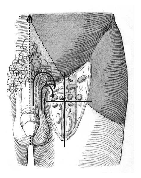 Figure 1 Anatomic Aspects Of Inguinal Lymph Nodes Applied To