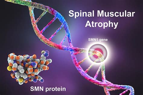 Sma Spinal Muscular Atrophy In Babies Causes And Treatment