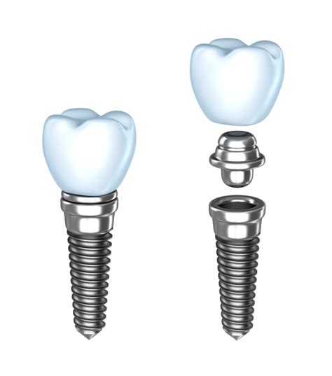 Dallas TX Dental Implants Jeff Colquitt DDS Restorative Dentistry