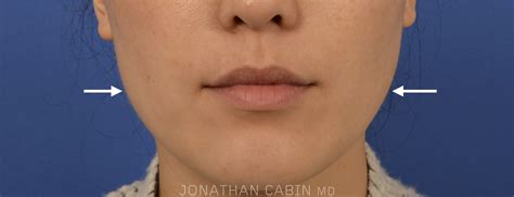 Jawline Slimming With Botox Overview Cost Recovery Before And After