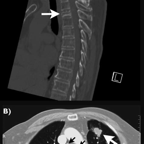 Conventional Radiographs Of The Thoracic Spine And The Chest On Initial