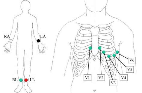 6 Positions Of Electrodes Used In A Standard 12 Lead Ecg Download