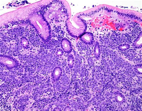 Diffuse Large B Cell Lymphoma Photograph By Webpathologyscience Photo