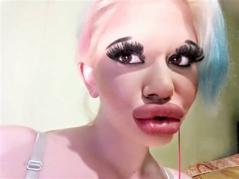 Bulgarian Woman Aspiring To Have Biggest Lips In The World Undergoes