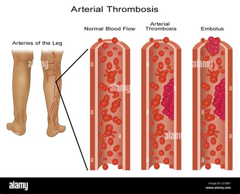 Illustration Of A Normal Leg Artery And Ones With Blood Clots Arterial