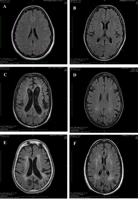 Figure 1 From Correlation Of Cerebral Atrophy And White Matter