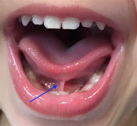 What Is A Tongue Tie And Its Causes Health2wellness Blog