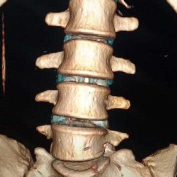 Tomografia Computadorizada De Coluna Lombossacra Revelando Mega
