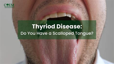 Thyroid Disease Do You Have A Scalloped Tongue Youtube