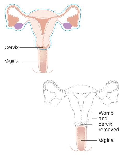 Hysterectomie Par Voie Vaginale Et Reparation Lieux De Drague Caen