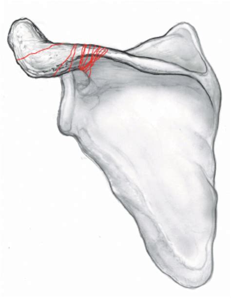 Ap Illustration Of The Scapula Showing The 13 Acromion Frac Ture